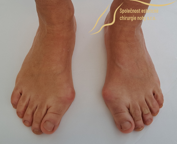 předoperační fotka nohou